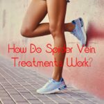 How Do Spider Vein Treatments Work