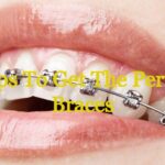 Steps To Get The Perfect Braces In Winnipeg